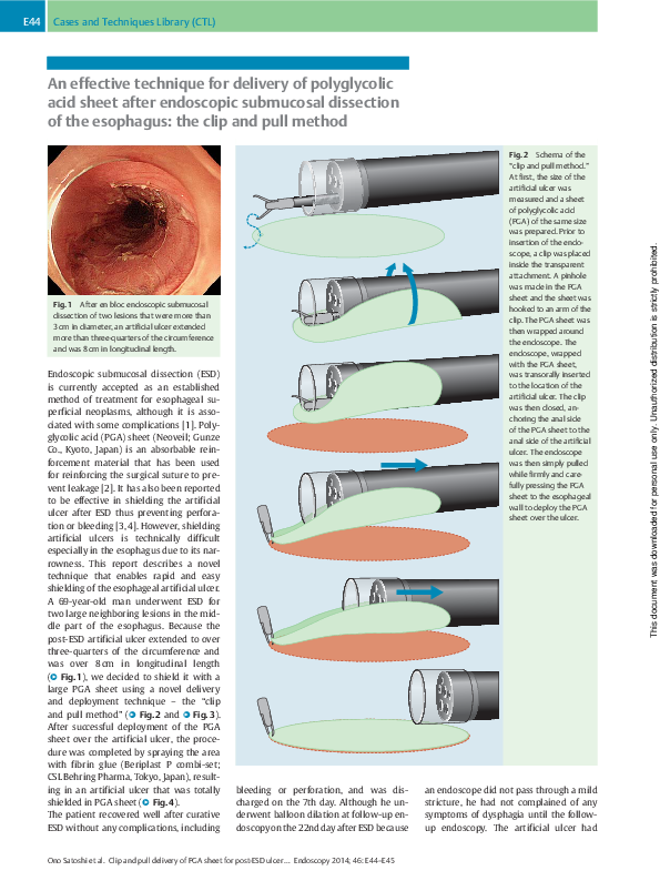 (PDF) An effective technique for delivery of polyglycolic acid sheet ...