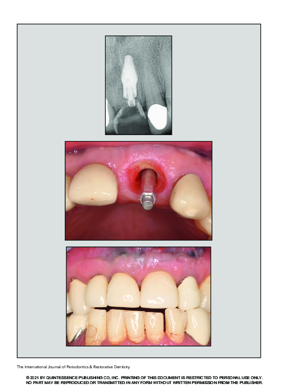 (PDF) A Novel Implant Design for Immediate Extraction Sites