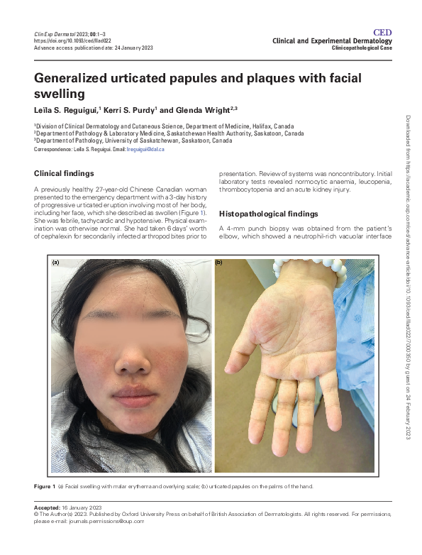 (PDF) Generalized urticated papules and plaques with facial swelling