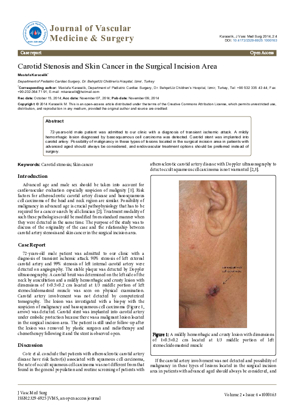 (PDF) Carotid Stenosis and Skin Cancer in the Surgical Incision Area