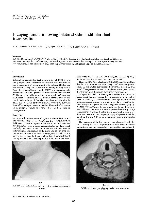 (PDF) Plunging ranula following bilateral submandibular duct transposition