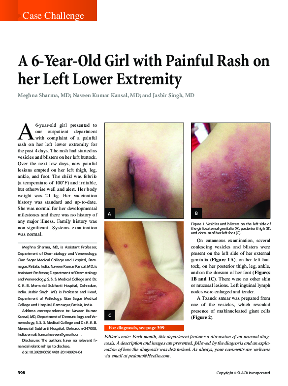 (PDF) A 6-Year-Old Girl with Painful Rash on her Left Lower Extremity