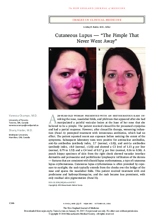 (PDF) Cutaneous Lupus — “The Pimple That Never Went Away”