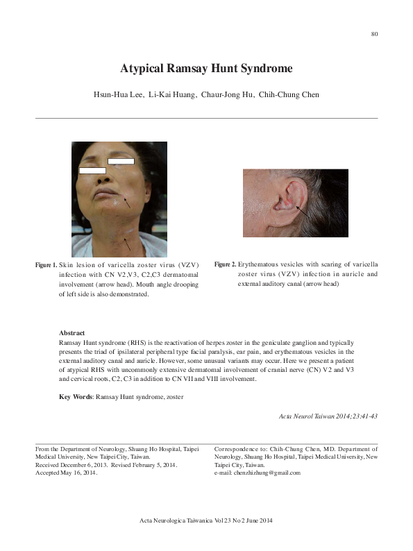 (PDF) Atypical Ramsay Hunt syndrome