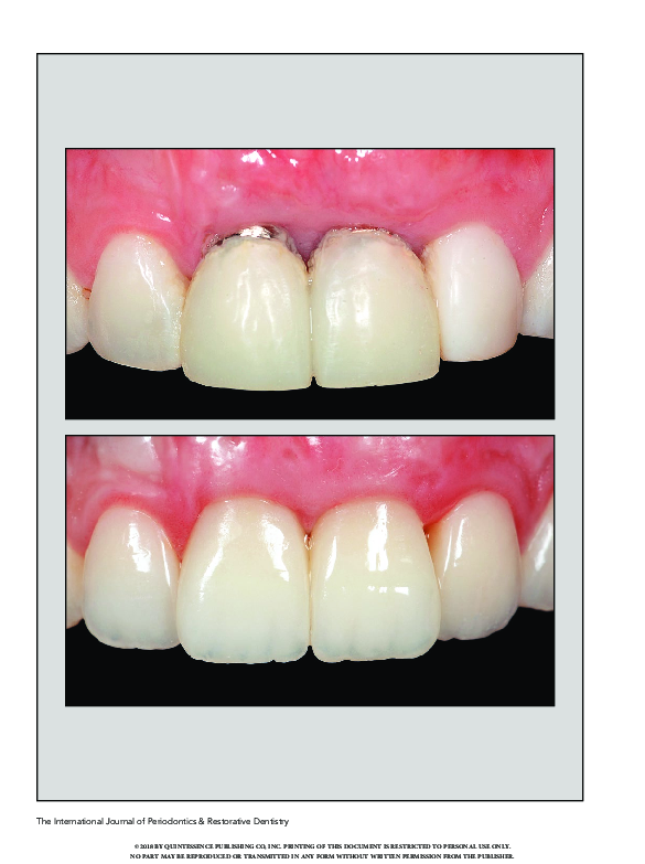 (PDF) The Effect of Implant Abutment Design on Long-Term Soft Tissue ...