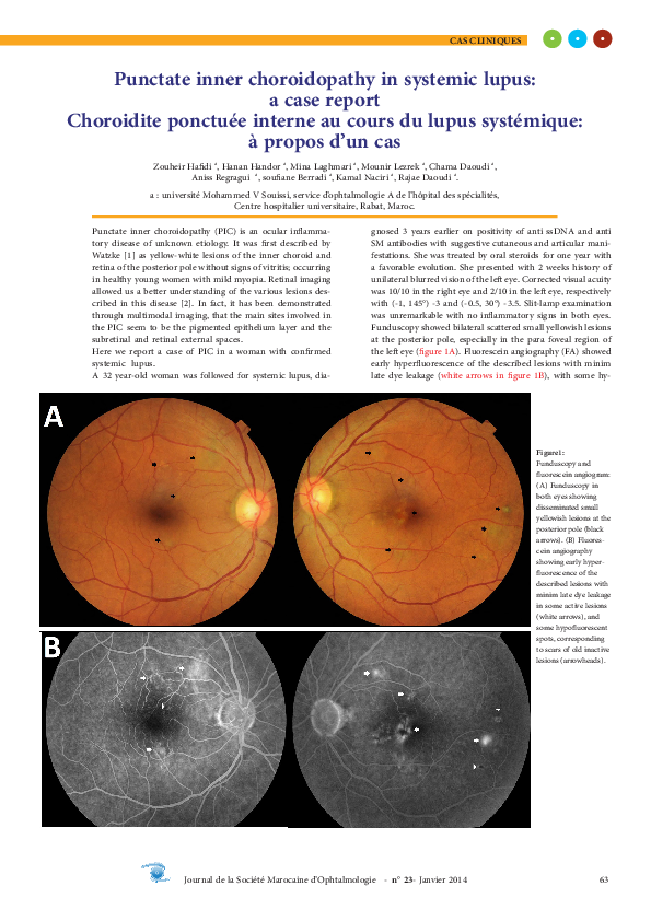 (PDF) Choroidite ponctuée interne au cours du lupus systémique: à ...