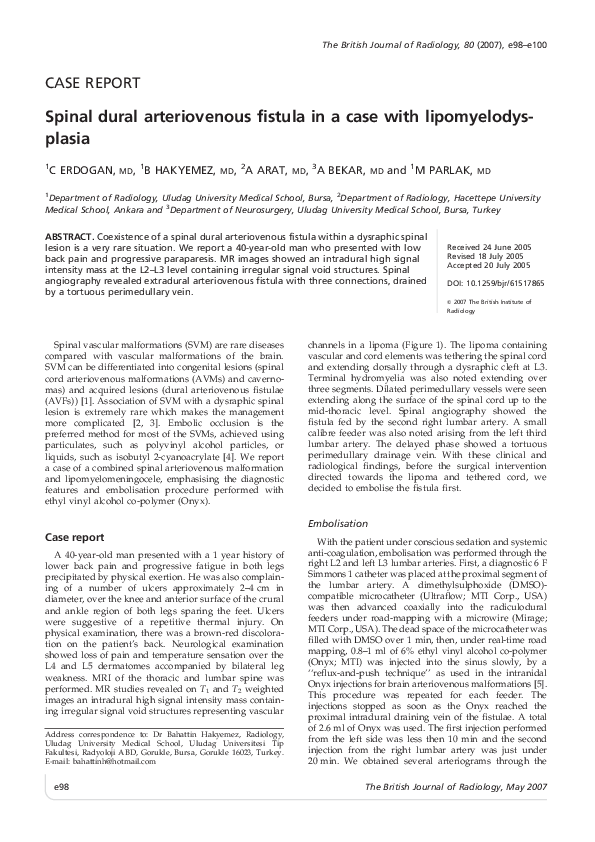 (PDF) Spinal dural arteriovenous fistula in a case with ...
