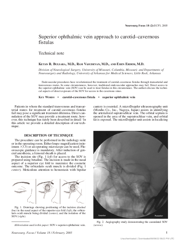 (PDF) Superior ophthalmic vein approach to carotid–cavernous fistulas