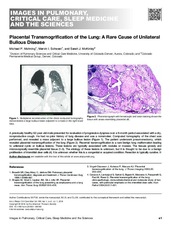 (PDF) Placental Transmogrification of the Lung A Rare Cause of