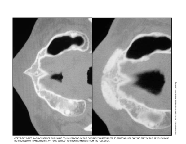 (PDF) The use of titanium mesh in conjunction with autogenous bone ...