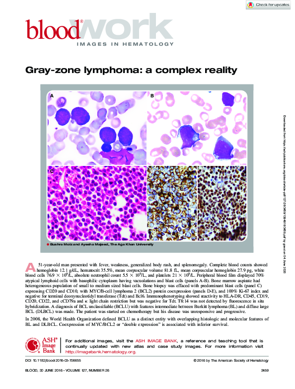 (PDF) Gray-zone lymphoma: a complex reality