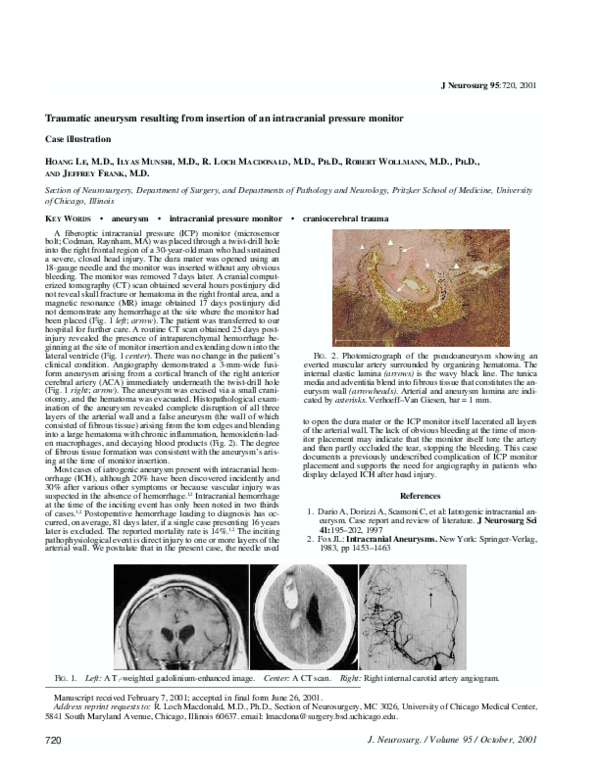 (PDF) Traumatic aneurysm resulting from insertion of an intracranial ...