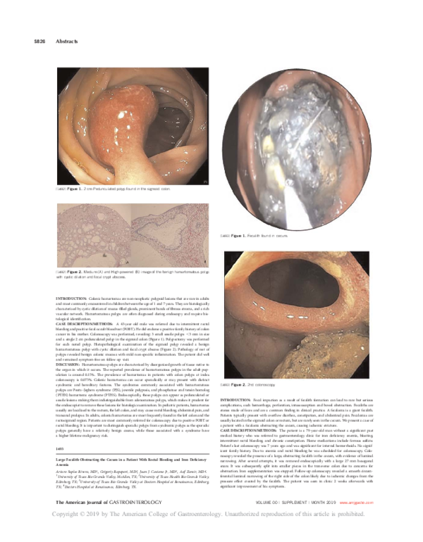 (PDF) Large Fecalith Obstructing the Cecum in a Patient With Rectal ...