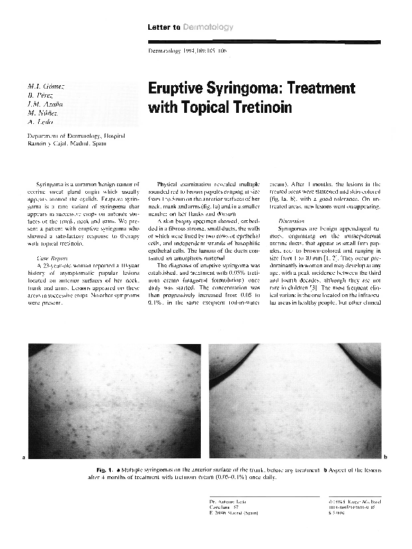 (PDF) Eruptive Syringoma Treatment with Topical Tretinoin José
