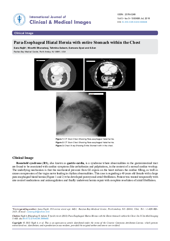 Para-Esophageal Hiatal Hernia with entire Stomach within the Chest