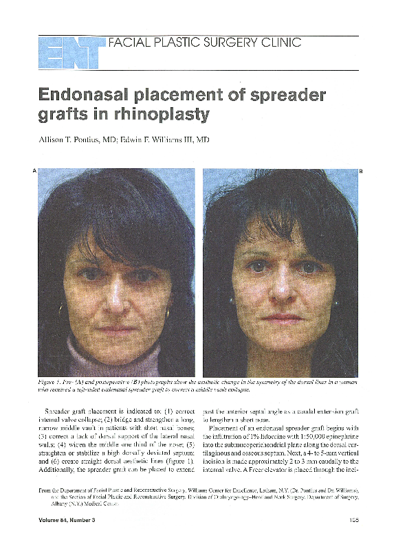 (PDF) Endonasal Placement of Spreader Grafts in Rhinoplasty Edwin