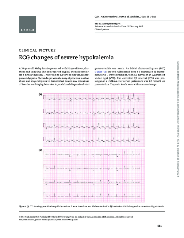 (PDF) ECG changes of severe hypokalemia