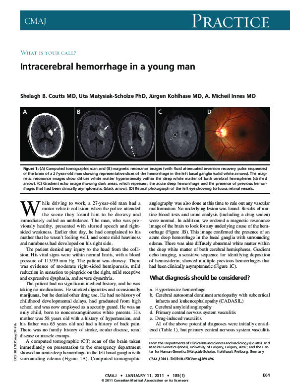 (PDF) Intracerebral hemorrhage in a young man