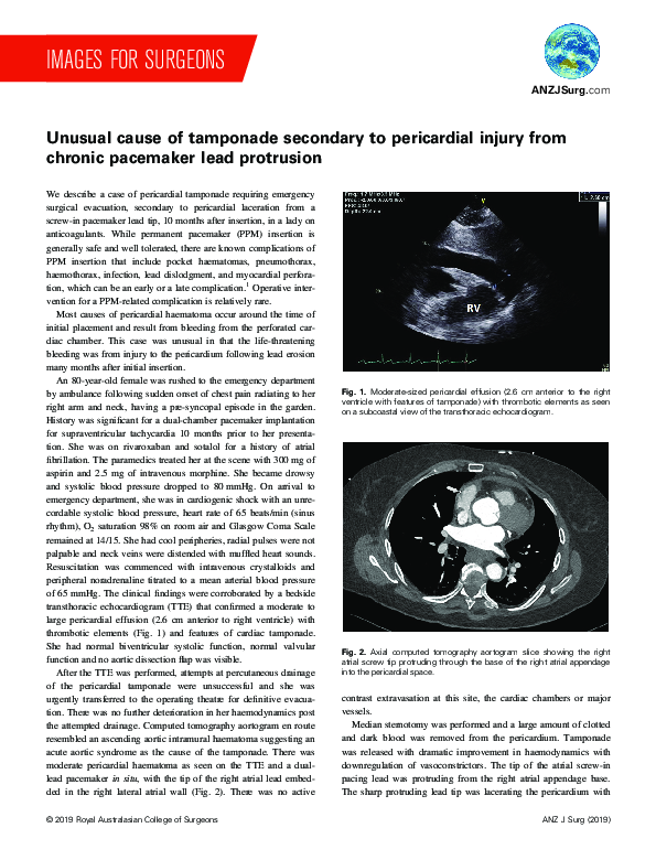 (PDF) Unusual cause of tamponade secondary to pericardial injury from ...