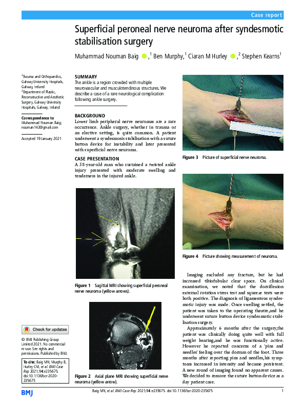 (PDF) Superficial peroneal nerve neuroma after syndesmotic ...