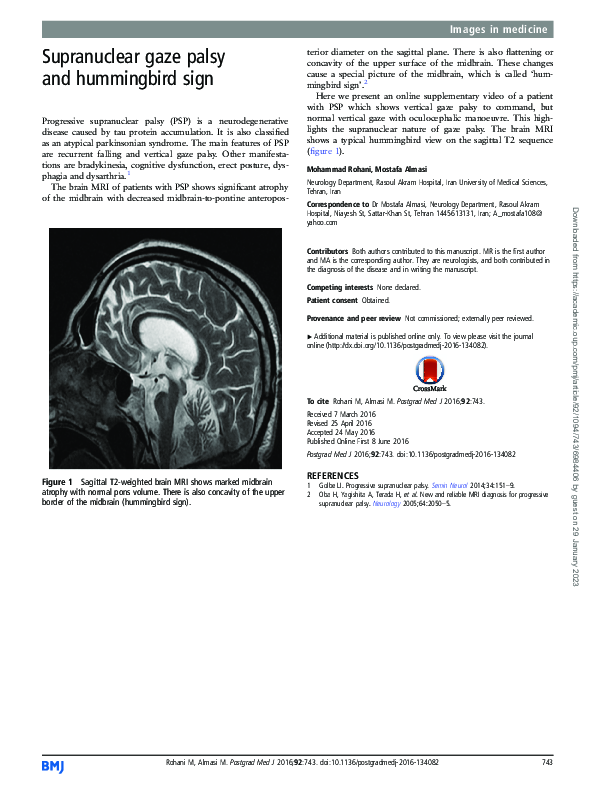 (PDF) Supranuclear gaze palsy and hummingbird sign
