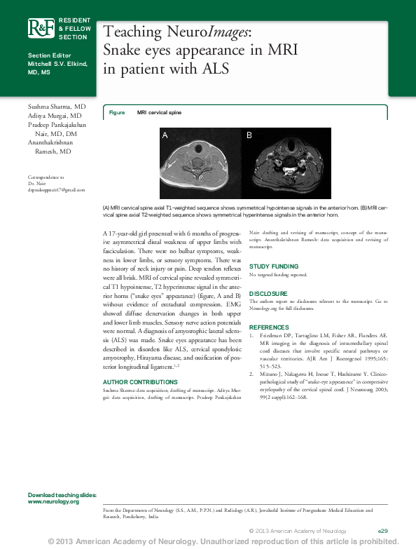 (PDF) Teaching NeuroImages: Snake eyes appearance in MRI in patient ...
