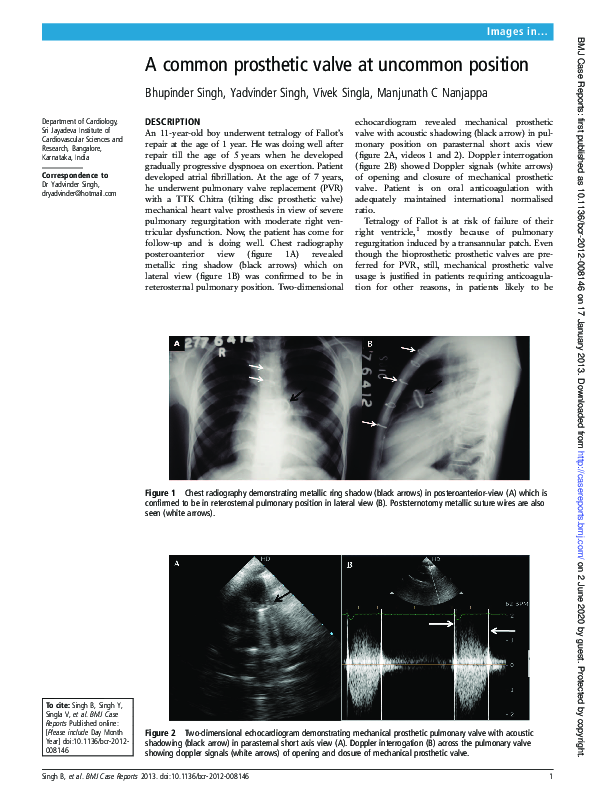(PDF) A common prosthetic valve at uncommon position