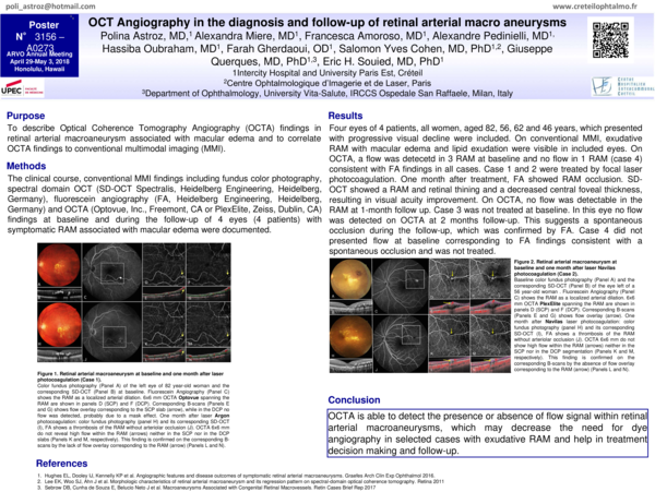 (PDF) OCT Angiography in the diagnosis and follow-up of retinal ...