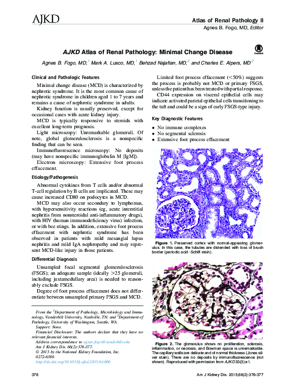 (PDF) AJKD Atlas of Renal Pathology: Minimal Change Disease