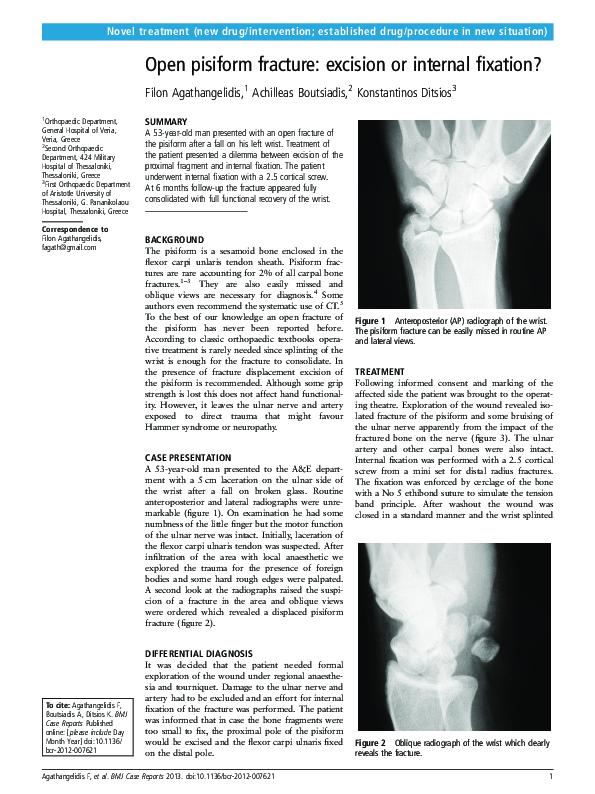 (PDF) Open pisiform fracture: excision or internal fixation?
