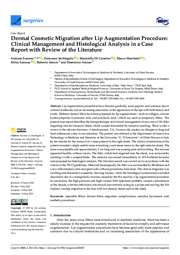 (PDF) Dermal Filler Migration After Lip Augmentation: A Case Study