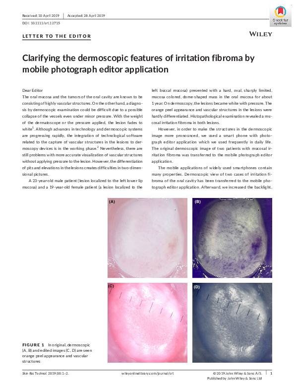 (PDF) Clarifying the dermoscopic features of irritation fibroma by ...