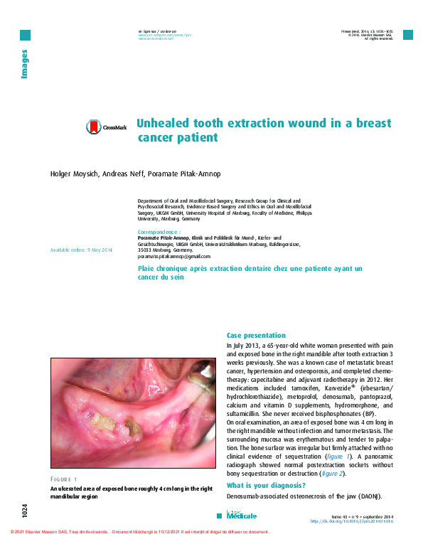 (PDF) Unhealed tooth extraction wound in a breast cancer patient