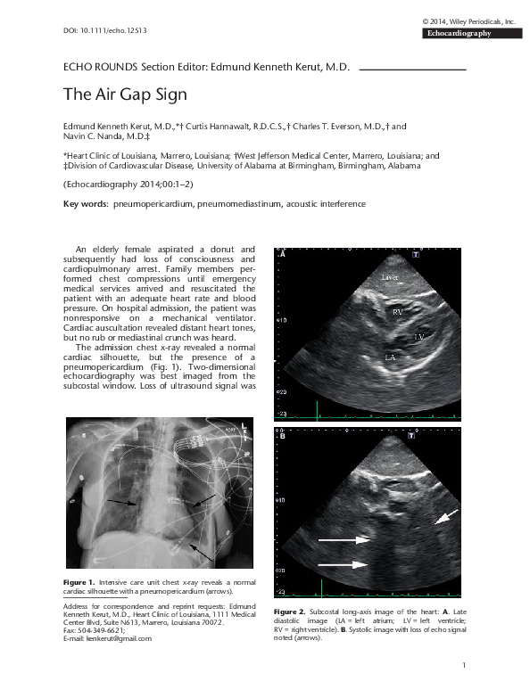 (PDF) The Air Gap Sign