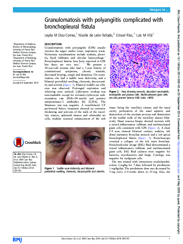 (PDF) Granulomatosis with polyangiitis complicated with bronchopleural ...