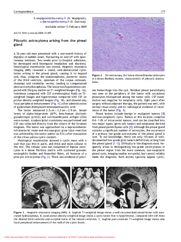 (PDF) Pilocytic astrocytoma arising from the pineal gland