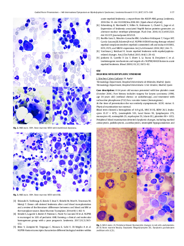 (PDF) High Risk Myelodysplastic Syndrome