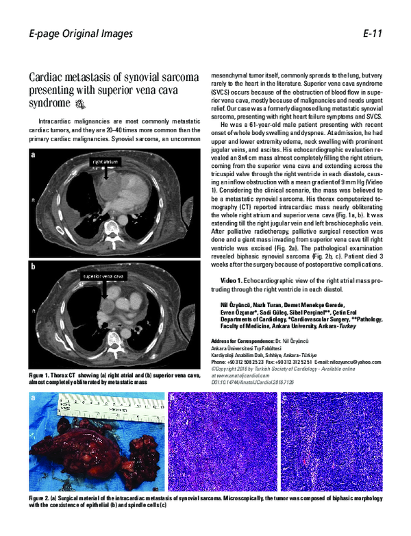 (PDF) Cardiac metastasis of synovial sarcoma presenting with superior ...