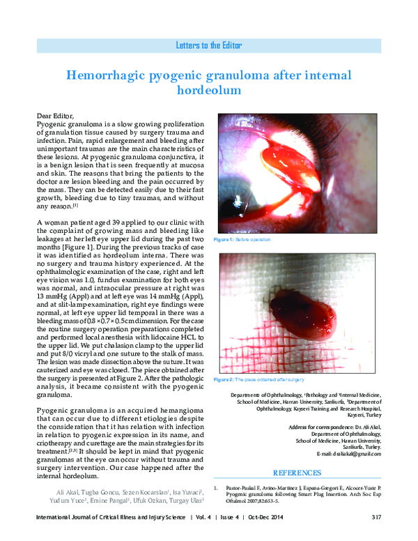 (PDF) Hemorrhagic pyogenic granuloma after internal hordeolum