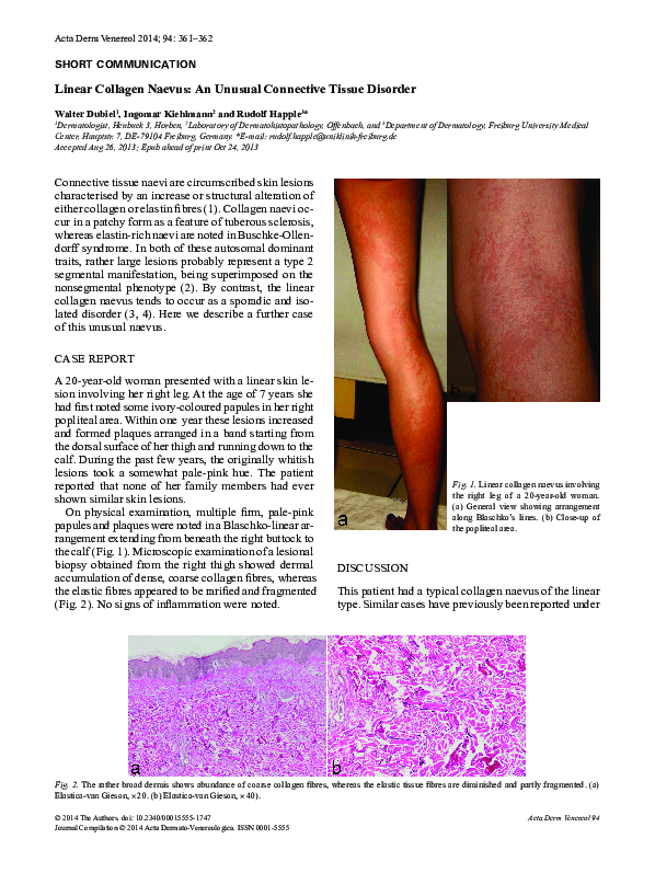 (PDF) Linear Collagen Naevus: An Unusual Connective Tissue Disorder