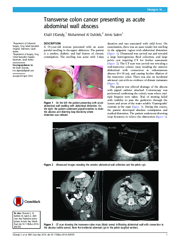 (PDF) Transverse colon cancer presenting as acute abdominal wall abscess