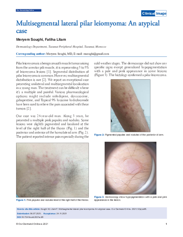 (PDF) Multisegmental lateral pilar leiomyoma: An atypical case