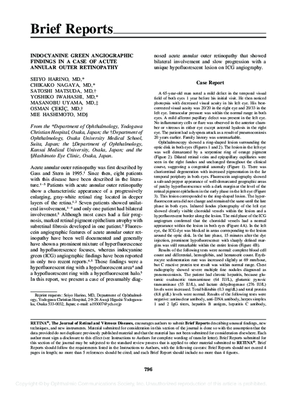 (PDF) Indocyanine green angiographic findings in a case of Harada’s disease