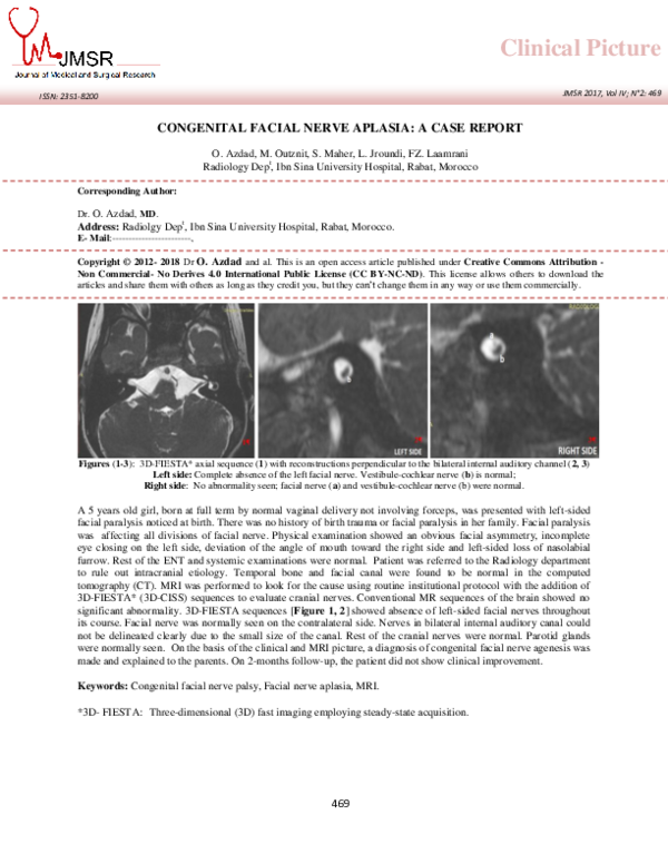 (PDF) Congenital facial nerve aplasia: a case report