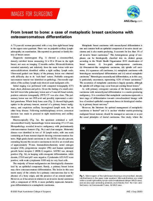 (PDF) From breast to bone: a case of metaplastic breast carcinoma with ...