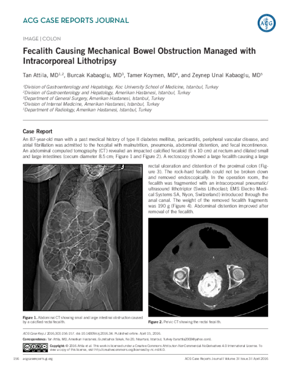 (PDF) Fecalith Causing Mechanical Bowel Obstruction Managed with ...
