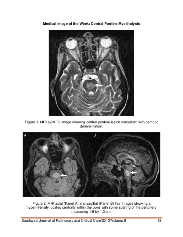 (PDF) Medical image of the week: central pontine myelinolysis