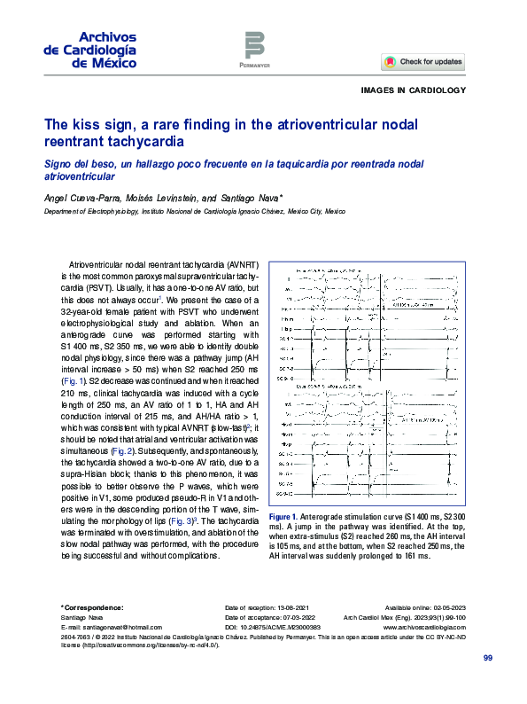 (PDF) The kiss sign, a rare finding in the atrioventricular nodal ...