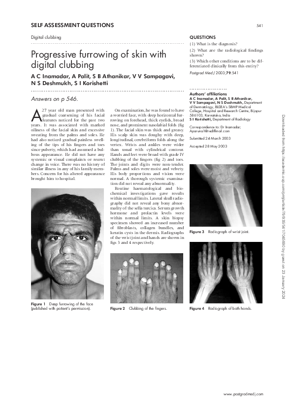 (PDF) Progressive furrowing of skin with digital clubbing