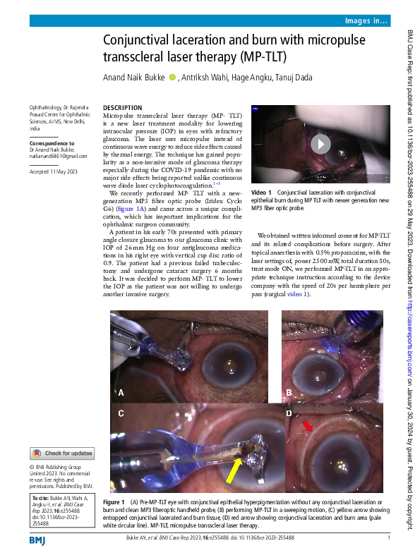 (PDF) Conjunctival laceration and burn with micropulse transscleral ...
